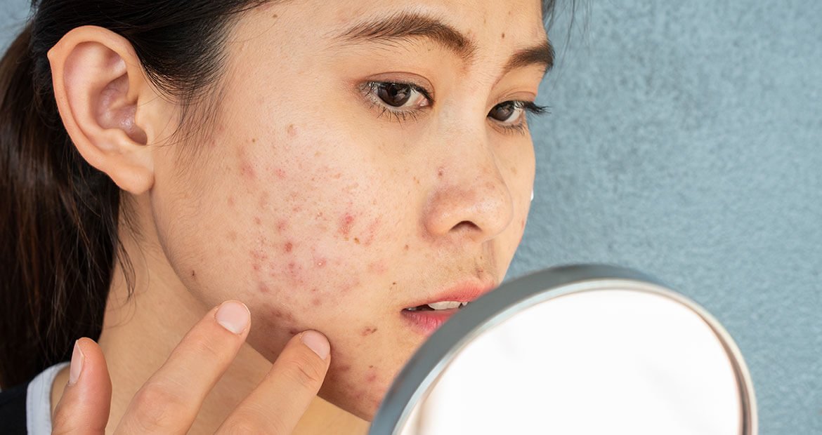 Saiba como tratar a acne hormonal | L'Oréal Paris